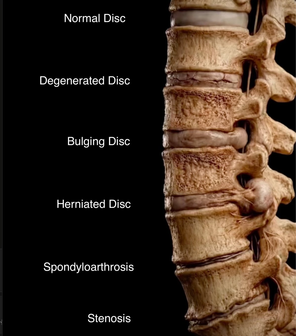 Spinal Decompression Chiropractor in Ridgefield, WA | ChiroRelief